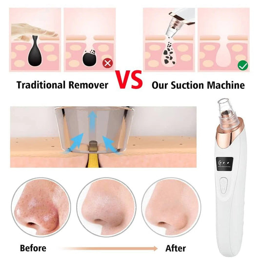 Blackhead Remover suction heads