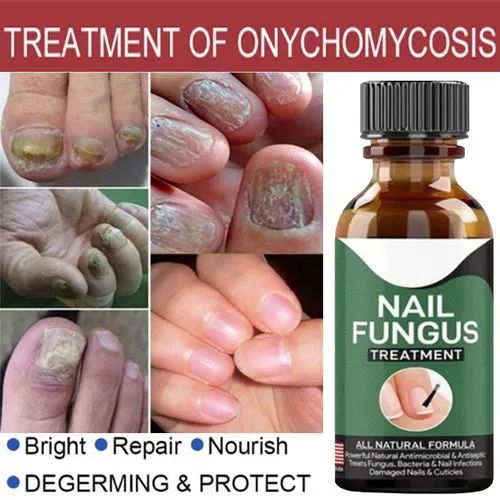 Fast Nail Fungal Treatments Nail Repair Serum