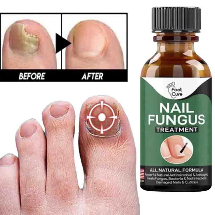 Fast Nail Fungal Treatments Nail Repair Serum