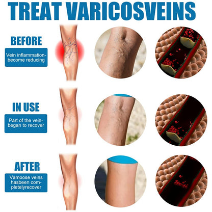 South Moon Varicose Veins Treatment Spray – 30ml Advanced Formula for Spider Veins, Leg Pain & Swelling Relief